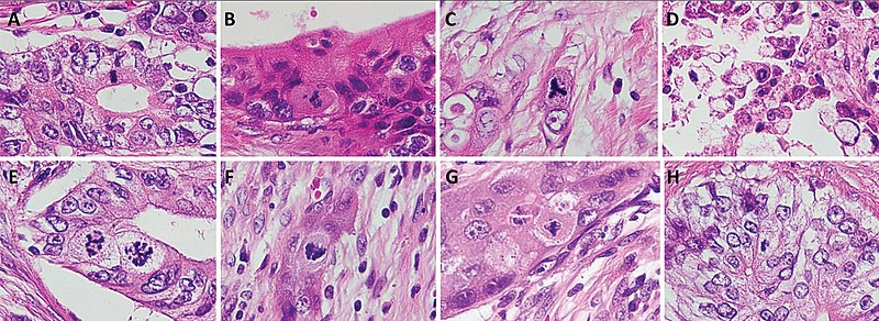 File:Normal versus atypical mitosis.jpg