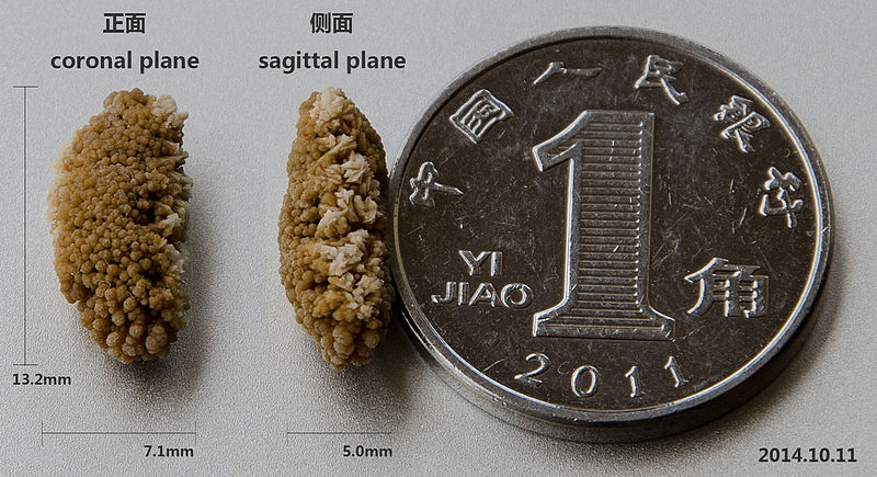 File:Lenticular kidney stone.jpg