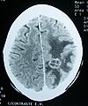 Article: Cerebral edema