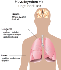 Huvudsymtomen vid pulmonell tuberkulos/lungtuberkulos (vänster) och de vanligaste organen som drabbas av sjukdomen utöver lungorna, det vill säga extrapulmonell tuberkulos (höger).