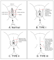 女陰殘割的類形圖，A.未經殘割的女陰；B.TYPE I：僅割除陰蒂；C.TYPE II：割除陰蒂及部分小陰唇；Ｃ.TYPE III：割除陰蒂、小陰唇並縫合，僅留下陰道口