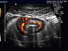 Ultraschallbild bei M. Crohn mit Wandverdickung und verstärkter Durchblutung einer Dünndarmschlinge