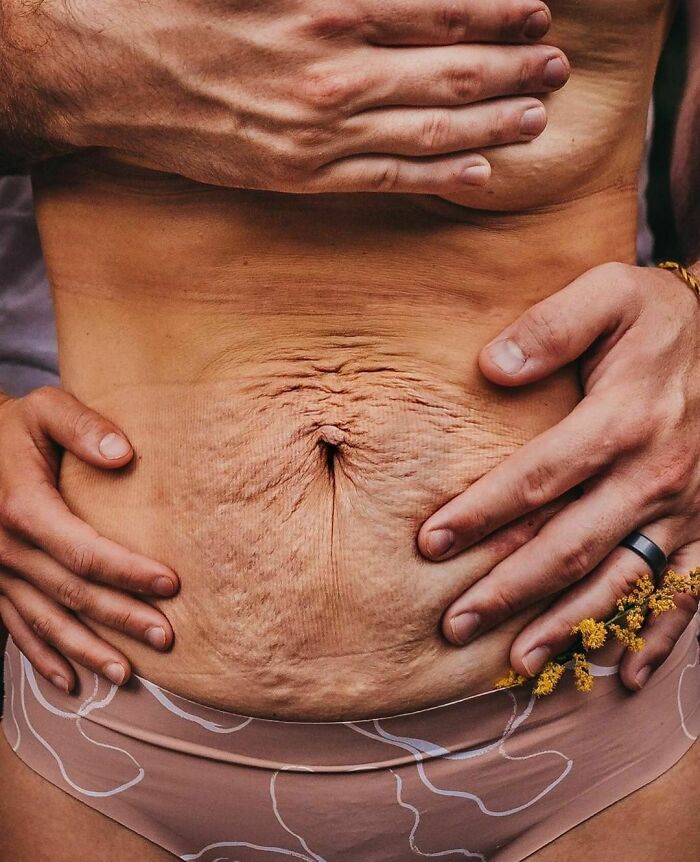 Close-up of a woman's postpartum belly with gently cradling hands, illustrating real-life beauty and transformation.